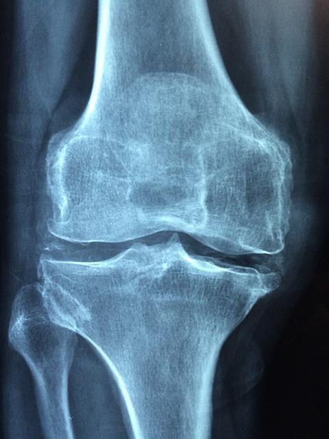 Jaké další terapeutické možnosti mohou pomoci ⁤s léčbou artrozy kolene vedle cvičení?